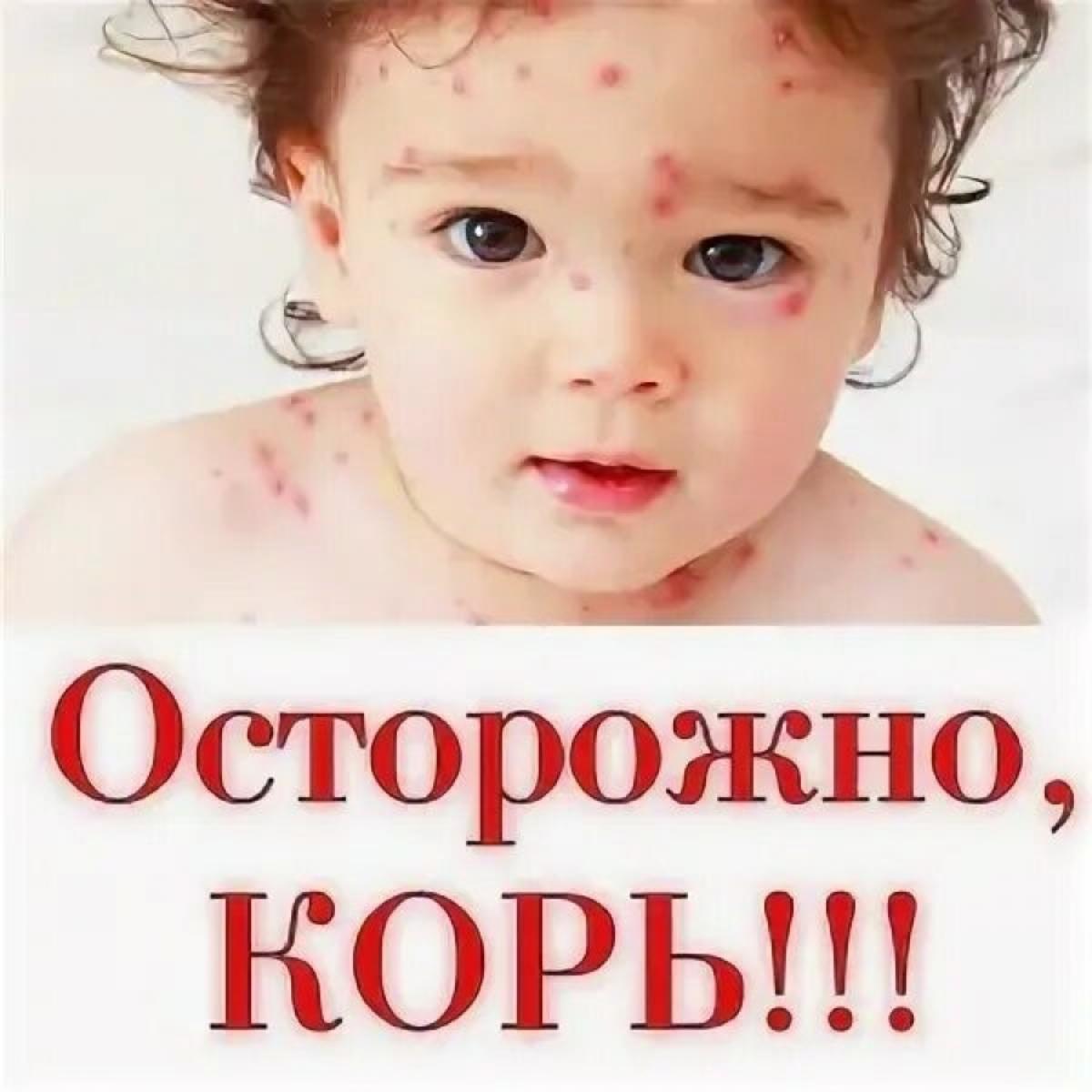 Семь главных вопросов про корь. Семь главных вопросов про корь.
