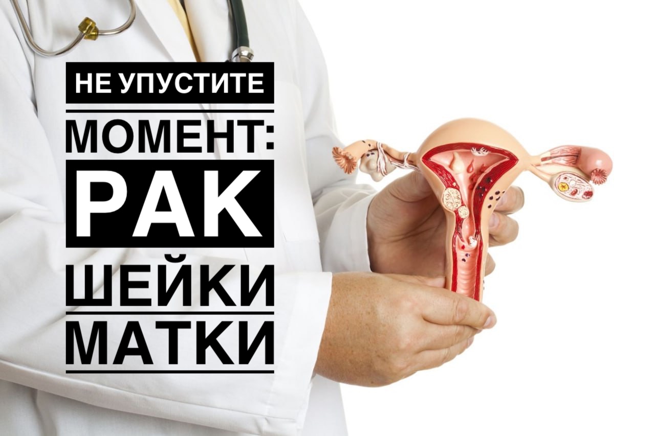 НЕ УПУСТИТЕ МОМЕНТ: РАК ШЕЙКИ МАТКИ НЕ УПУСТИТЕ МОМЕНТ: РАК ШЕЙКИ МАТКИ