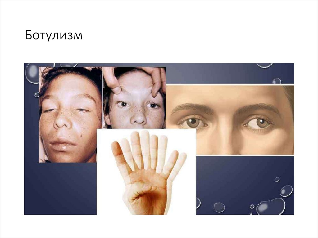 О профилактике ботулизма О профилактике ботулизма