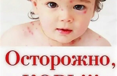 Семь главных вопросов про корь.
