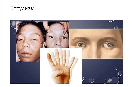 О профилактике ботулизма